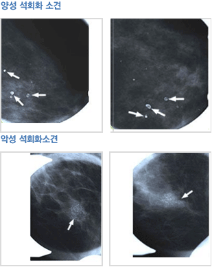 유방촬영 이미지