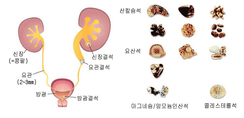 요로결석 원인. 신장(=콩팥), 요관(2~3mm), 방광, 방광결석, 요관결석, 신장결석,  종류:산칼슘석, 요산석, 마그네슘/암모늄인산석, 콜레스테롤석