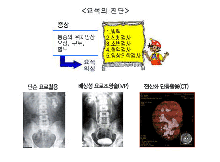 요석의 진단. 증상: 통증의 위치양상- 오심, 구토, 혈뇨 ->요석의심. 1.병력 2.신체검사, 3.소변겸사, 4.혈액검사, 5.영상의학검사. 단순 요로촬용, 배상성 요로조영술(IVP), 전산화 단층촬용(CT)