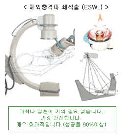 체외충격파 쇄석술(ESWL). 마취나 입원이 거의 필요 없습니다. 가장 안전합니다. 매우 효과적입니다. (성공률 90% 이상)