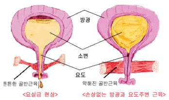 요실금 현상. 손상없는 방광과 요도주변 군육