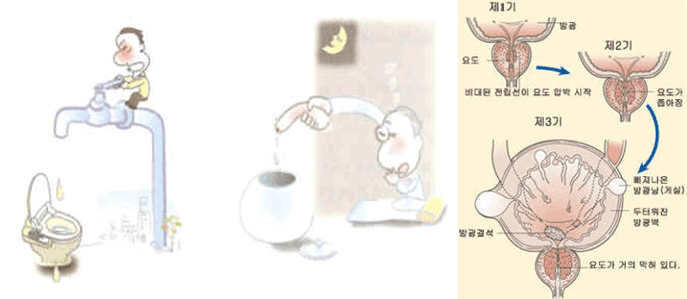 제1기:비대된 전립선이 요도 압박 시작. 2기: 요도가 좁아짐. 3기: 요도가 거의 막혀 있다. 