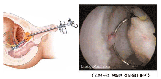 강요도적 전립선 절제술(TURP)