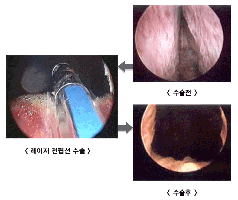레이저 전립선 수술