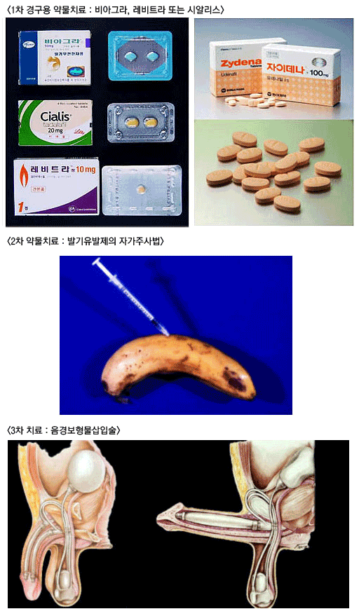 1차 경구용 약물치료 : 비아그라, 레비트라 또는 시알리스. 2차 약물치료 : 발기유발제의 자가 주사법. 3차 치료 : 음경 보형물삽입술.