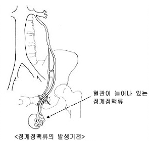 정계정맥류의 발생기전
