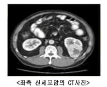 좌측 신세포암의 CT사진