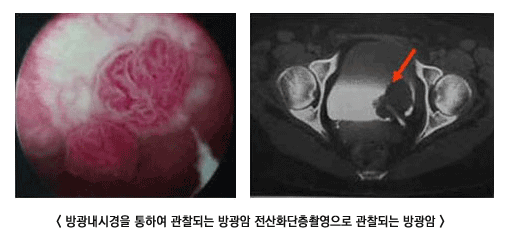 방광내시경을 통하여 관찰되는 방광암 전산화단층활영으로 관찰되는 방광암