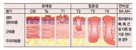 방광암의 병기 > 표재성. CIS , Ta, T1,  침윤성 T2, T3, T4, 전이성 N+, M+ 림프절이나 뼈, 페, 간 등 다른 장기로 전이된 경우.